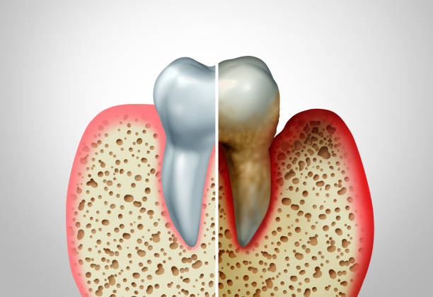 osteoporosis and teeth