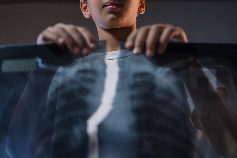 Osteoporosis-Pseudoglioma Syndrome