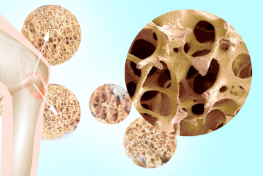 Is bone demineralization the same as osteoporosis