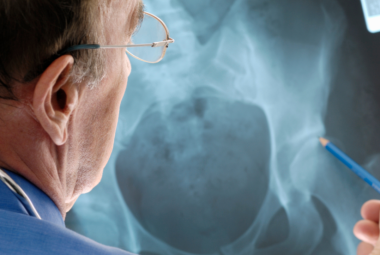 Transient Osteoporosis