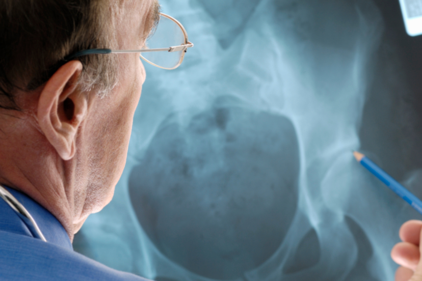 Transient Osteoporosis