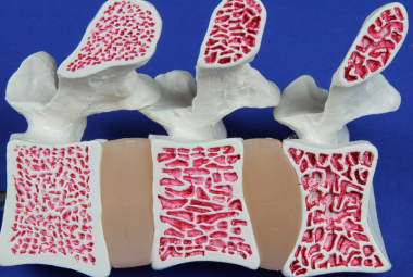 stages of osteoporosis
