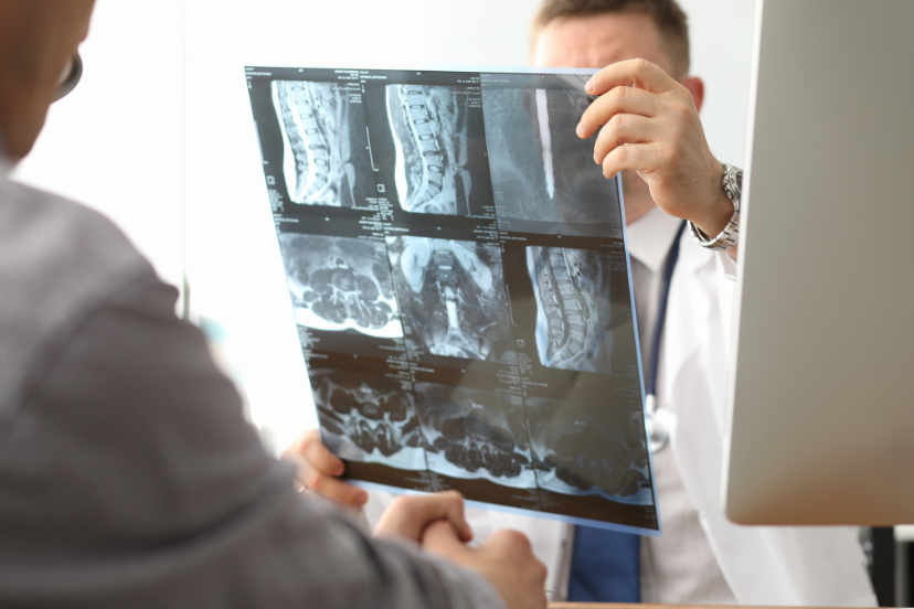 osteoporosis fracture risk
